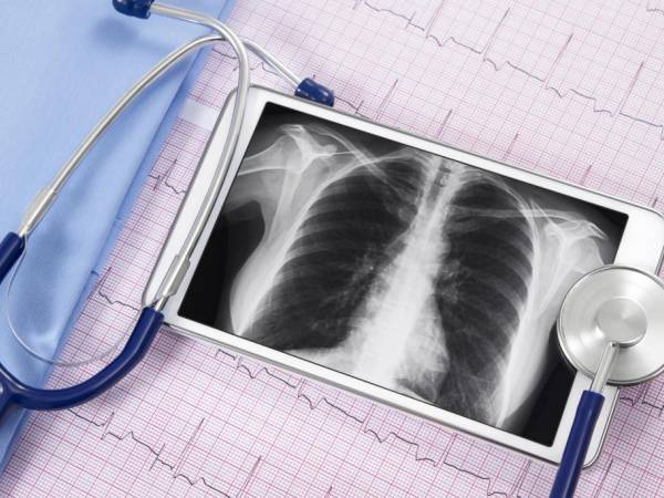 Chest X-Ray