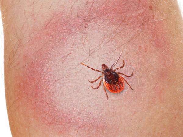 Deer tick on persons calf with red skin rash circling tick 