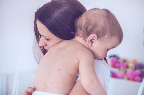 Mother holding baby with chickenpox