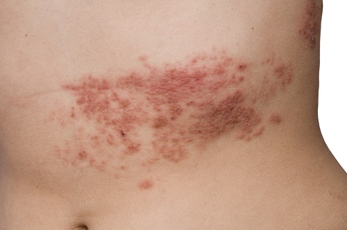Close-up of person with shingles infection