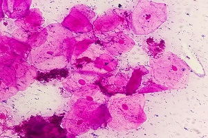 Bacterial Vaginosis