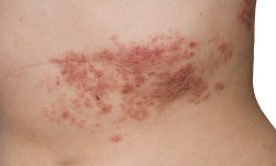 Close-up of person with shingles infection